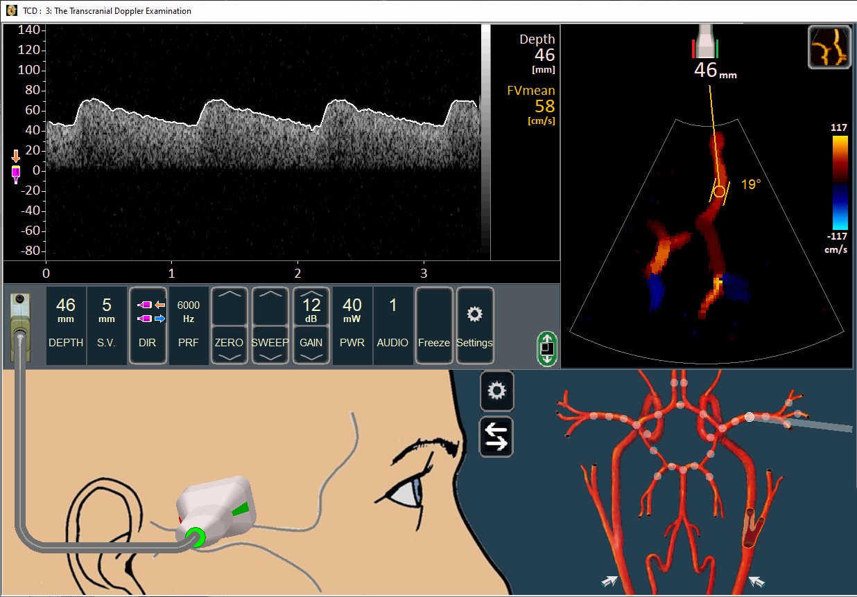 ICA stenosis example